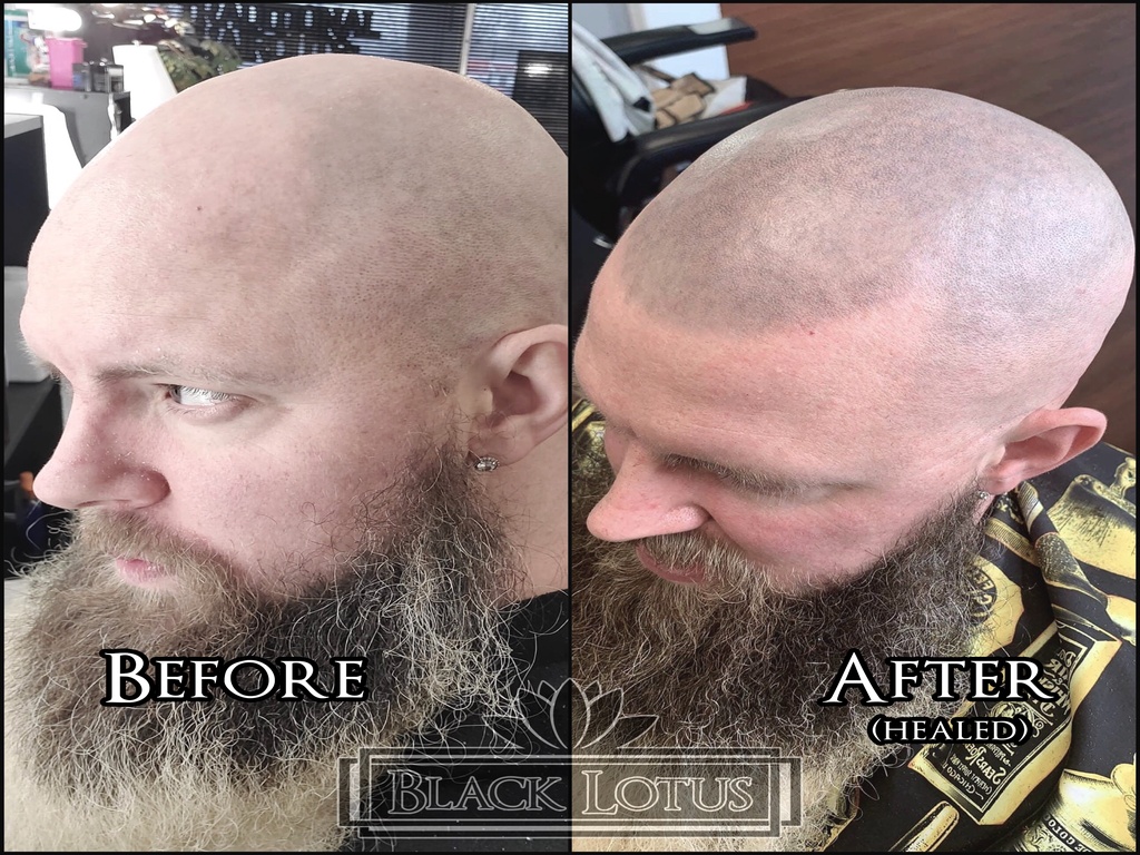 Scalp micropigmentation